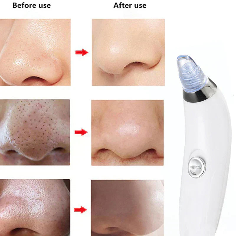 4 in 1 Derma Blackhead Remover Machine